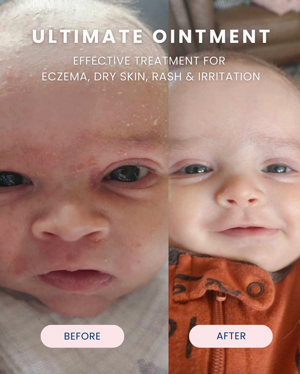 A before-and-after comparison graphic for a baby ointment, showing a close-up of a baby's face with eczema and dry skin on the left ('BEFORE') and a calmer, healed-looking face on the right ('AFTER'). Large text at the top reads 'ULTIMATE OINTMENT' and smaller text says it is effective for eczema, dry skin, rash & irritation.