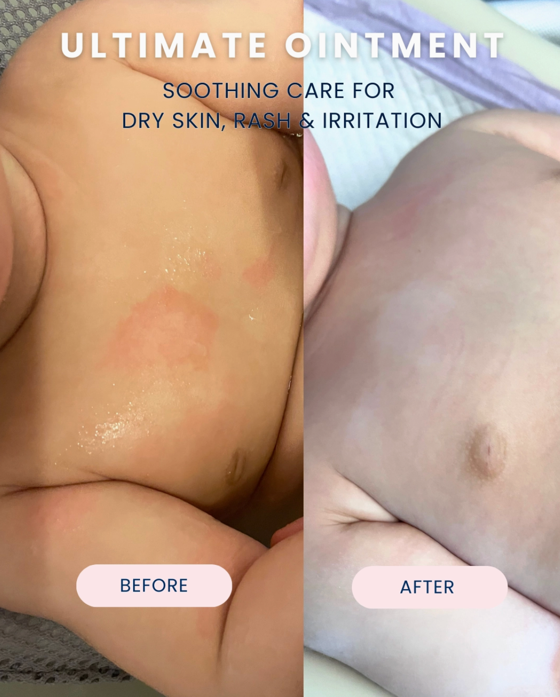 Before-and-after split-screen comparison of a baby's skin, showing red, irritated skin on the left labeled 'BEFORE' and smooth, healed skin on the right labeled 'AFTER'. Large text at the top reads 'ULTIMATE OINTMENT' and 'SOOTHING CARE FOR DRY SKIN, RASH & IRRITATION'.
